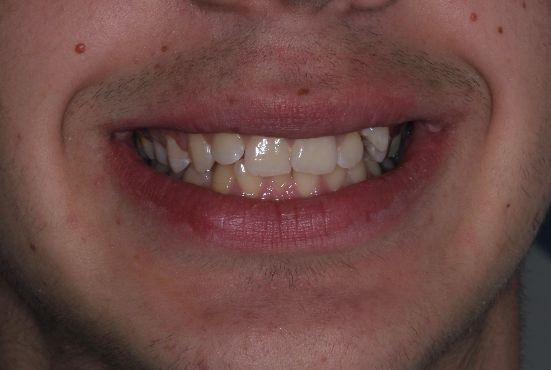 Persona sonriente mostrando los dientes, piel clara, dientes ligeramente amarillentos, labios rosados.