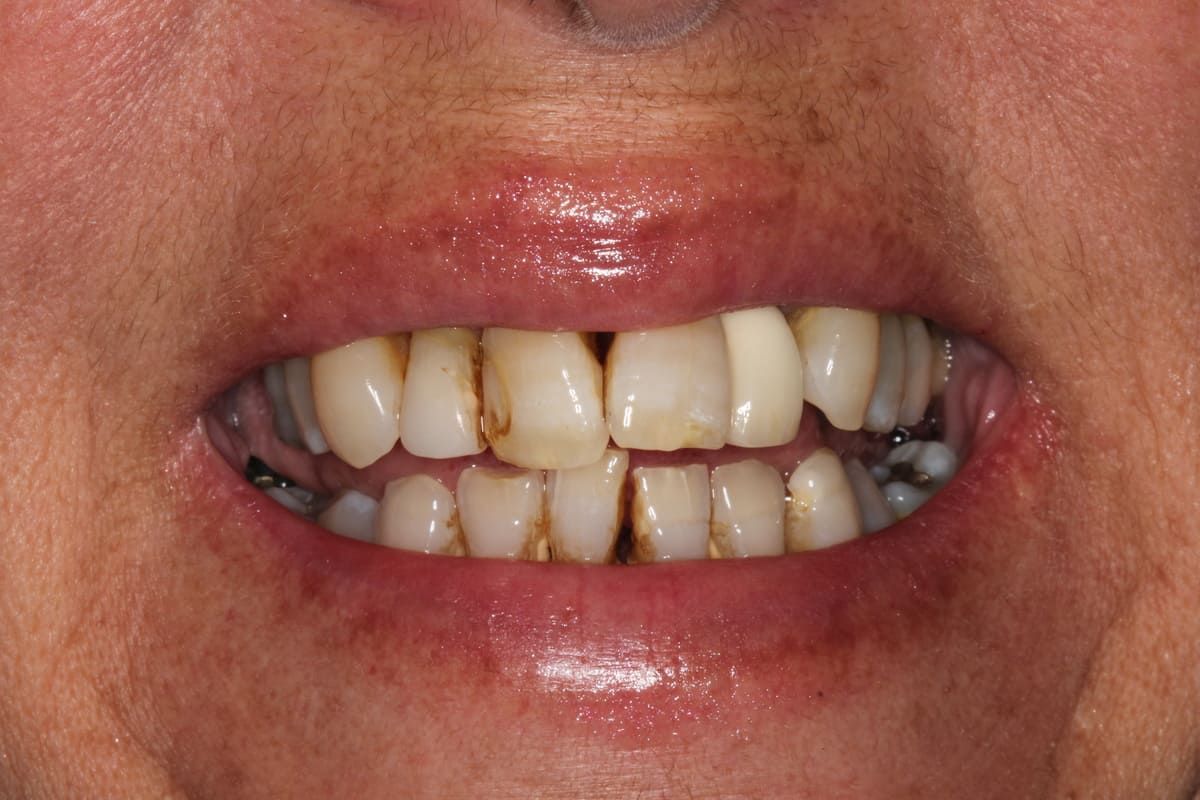 Un primer plano de la boca de una mujer sin dientes.