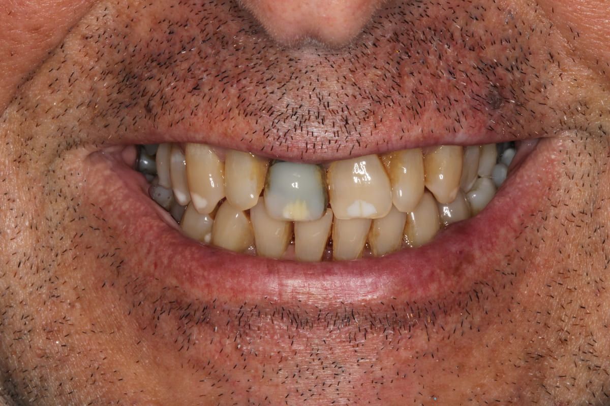 Un primer plano de la boca de una mujer sin dientes.