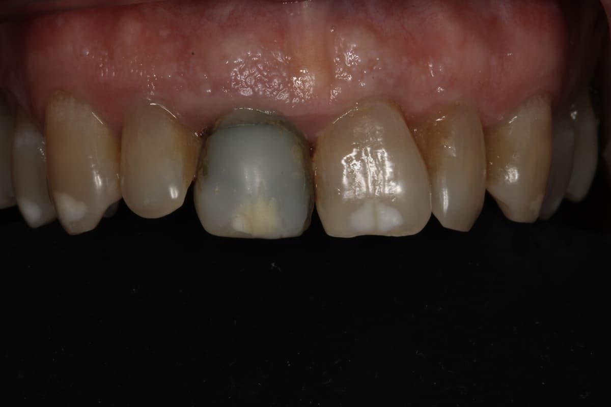 Un primer plano de los dientes de una persona con un fondo negro.