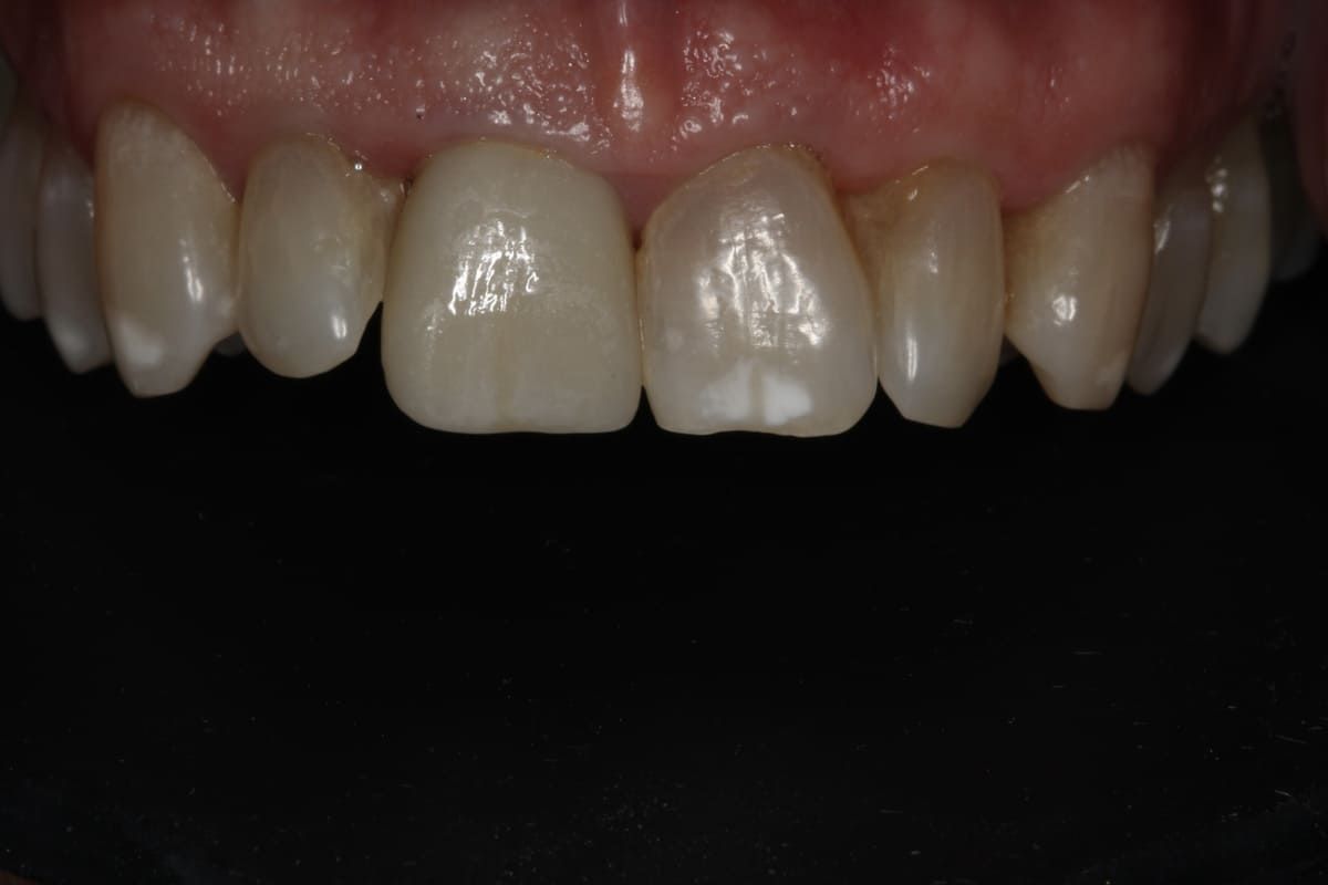 Un primer plano de los dientes de una persona sobre un fondo negro.