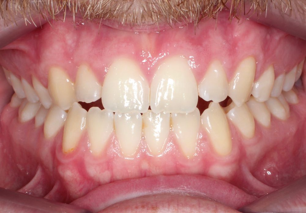 Primer plano de los dientes, donde se aprecia un espacio notable entre los incisivos superiores y un ligero apiñamiento.