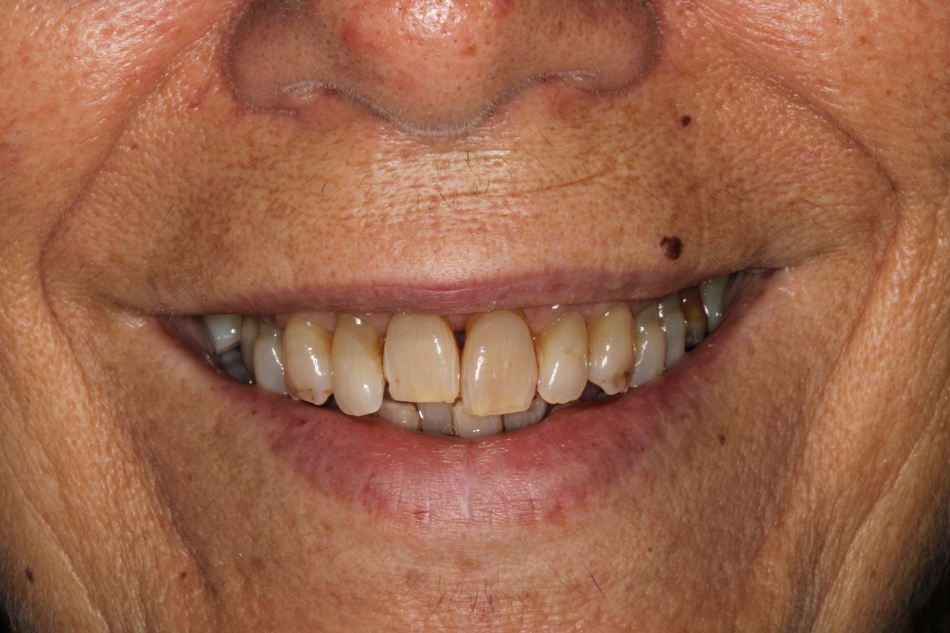 Un primer plano de los dientes de una persona sobre un fondo negro.