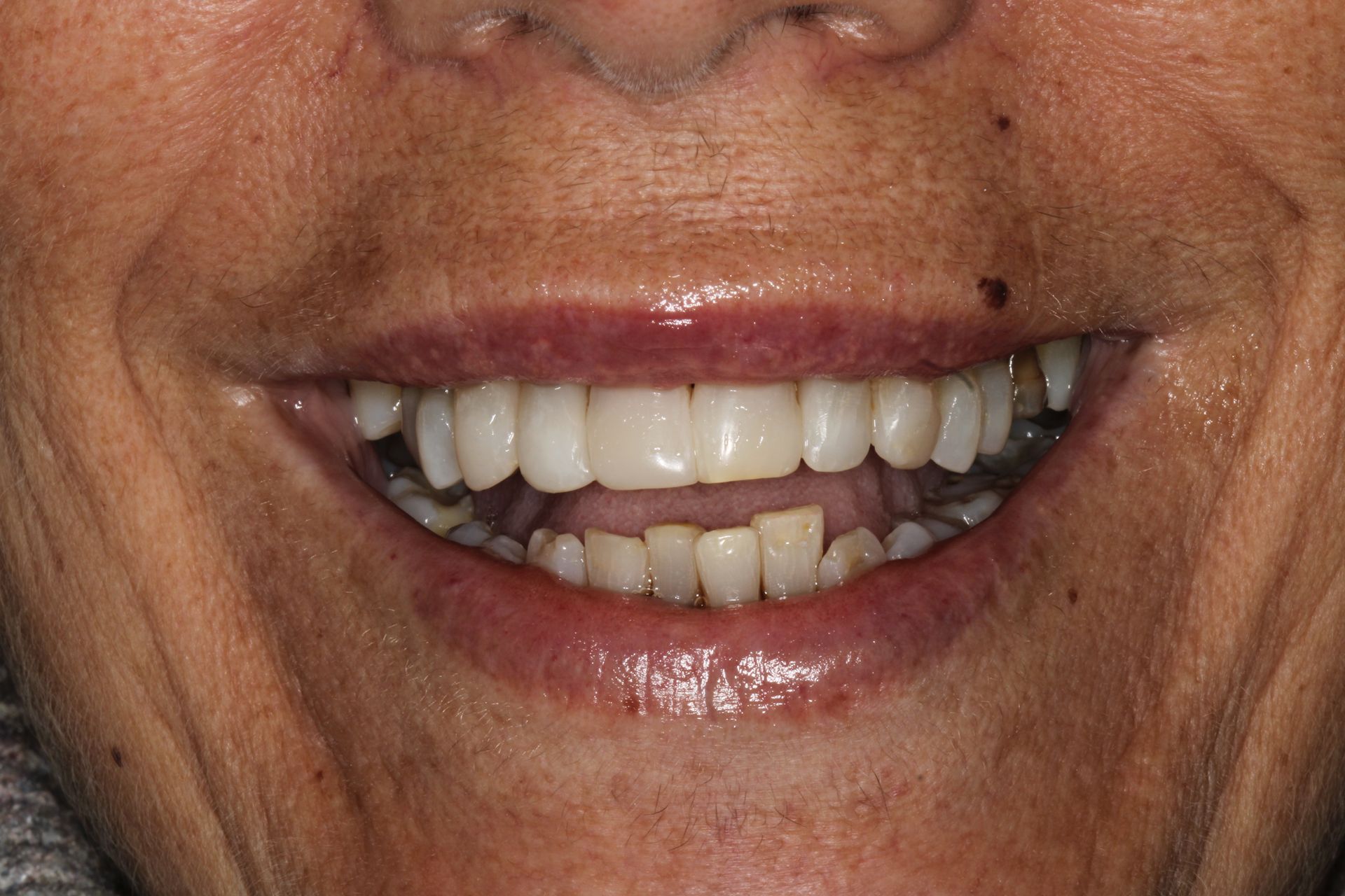Un primer plano de los dientes de una persona sobre un fondo negro.