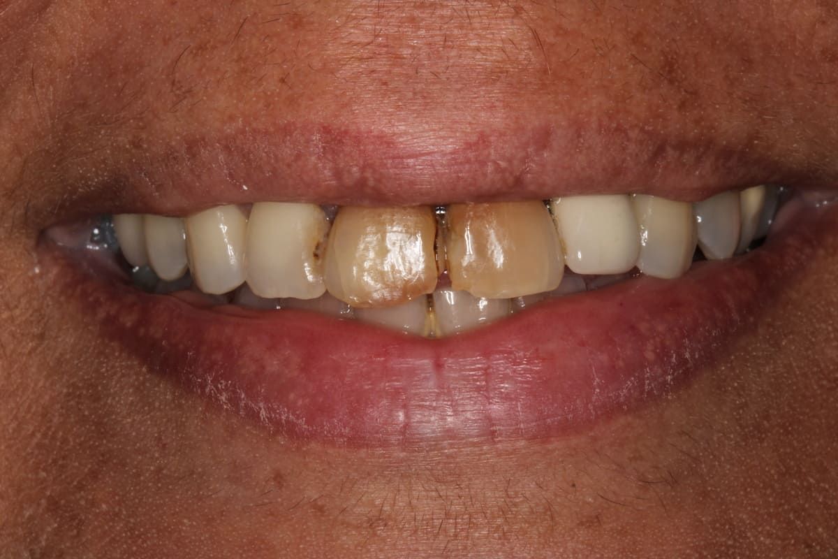 Un primer plano de los dientes de una persona sobre un fondo negro.