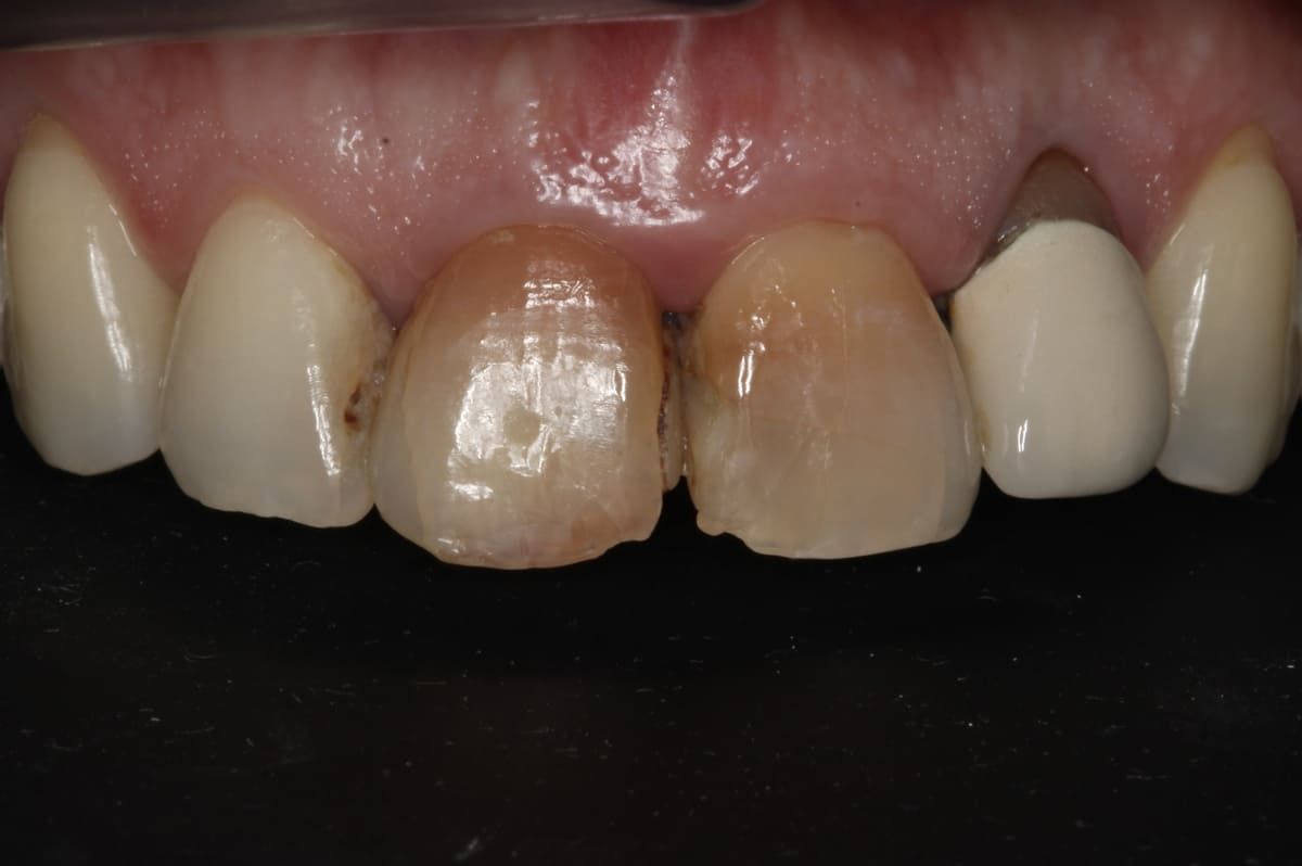 Un primer plano de los dientes de una persona sobre un fondo negro.