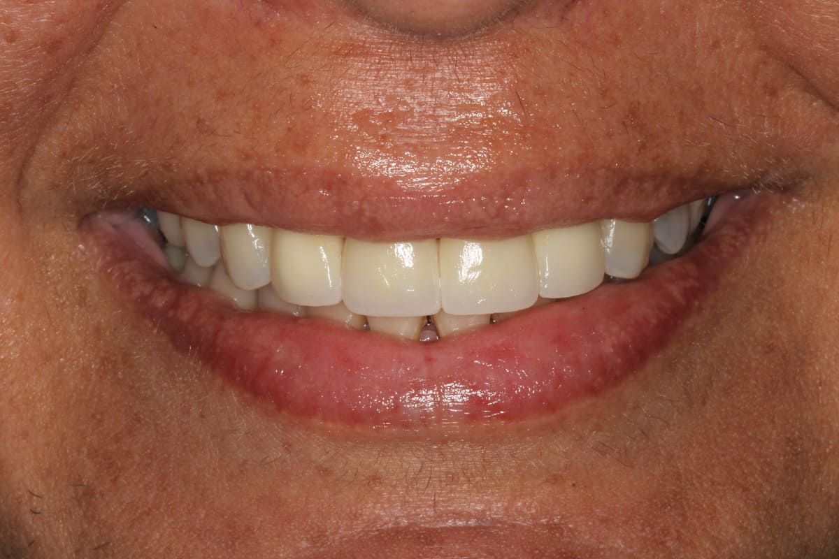 Un primer plano de los dientes de una persona sobre un fondo negro.