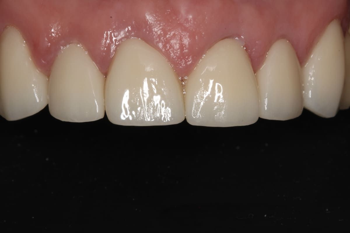 Un primer plano de los dientes de una persona sobre un fondo negro.
