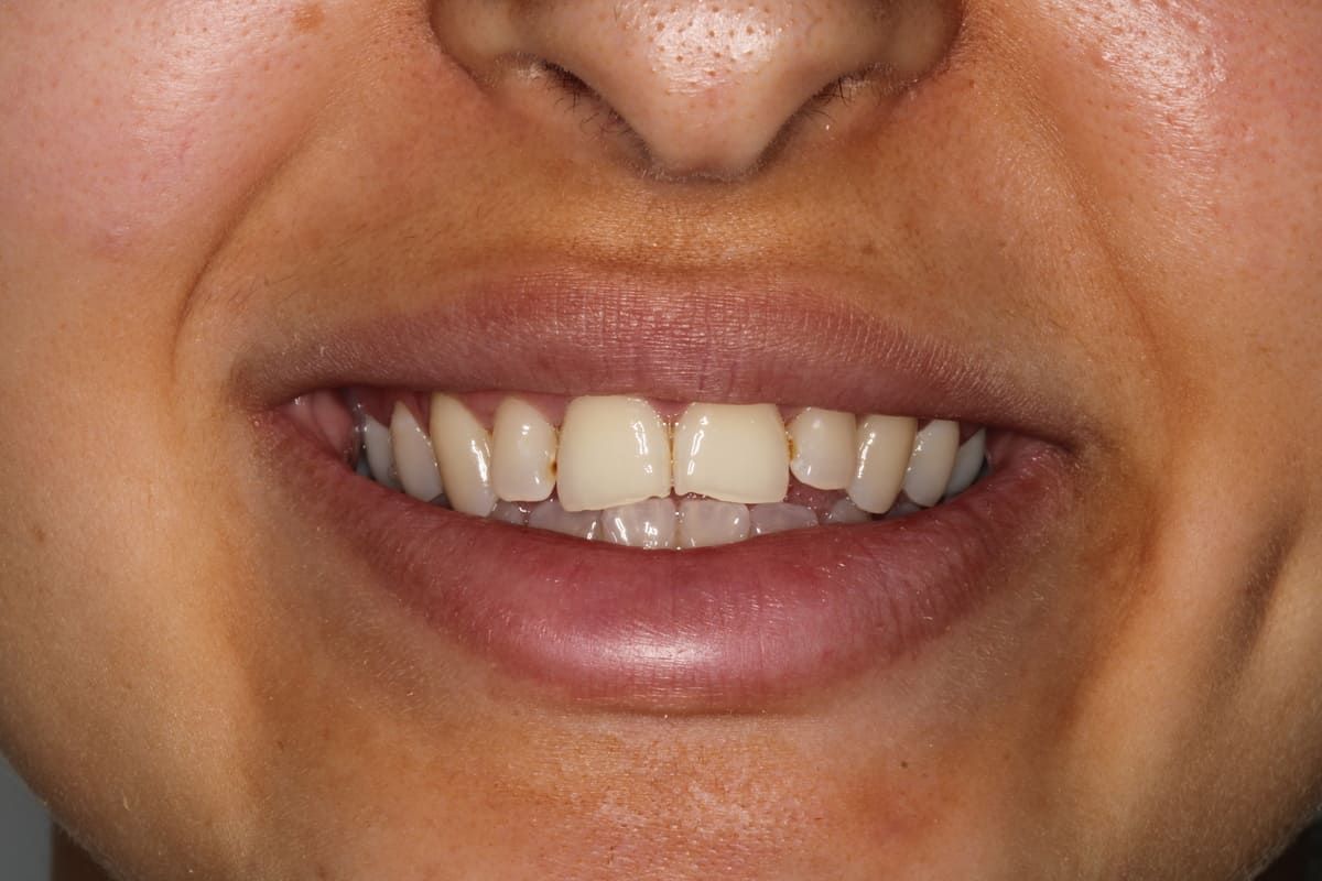 Un primer plano de la boca de una mujer sin dientes.
