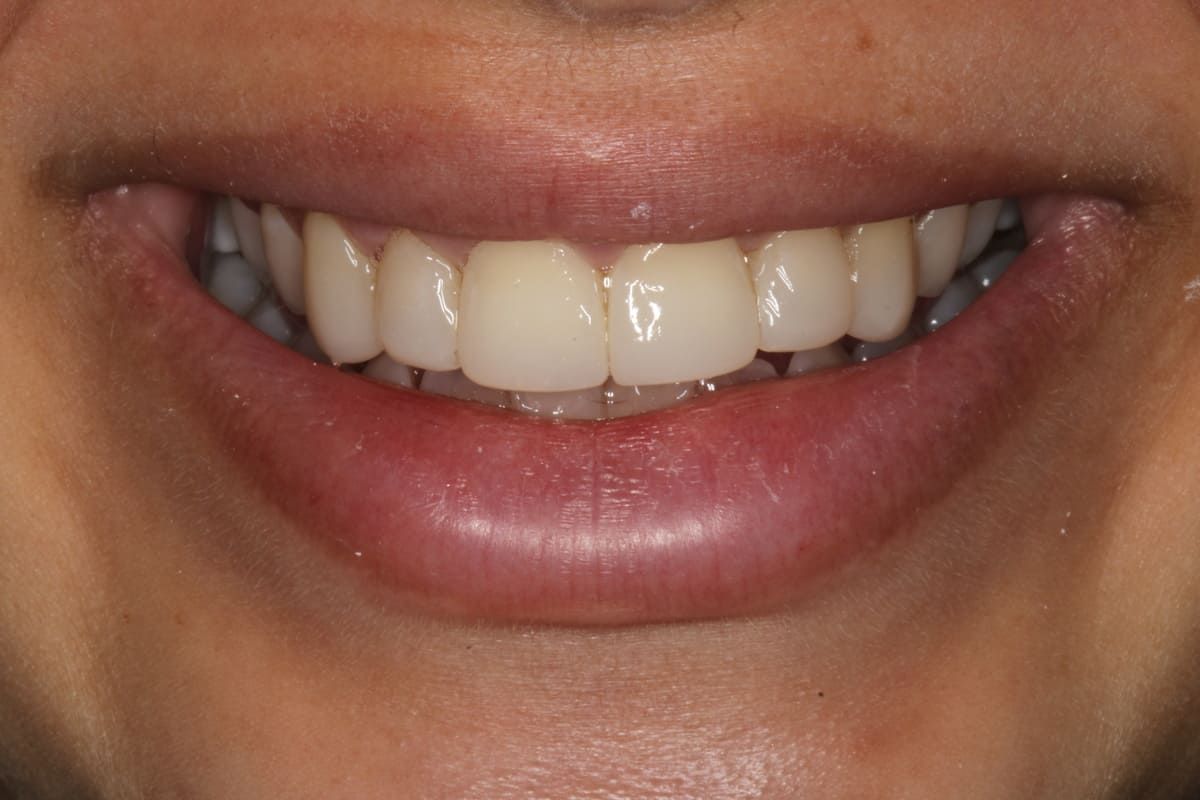 Un primer plano de la sonrisa de una mujer con dientes blancos.