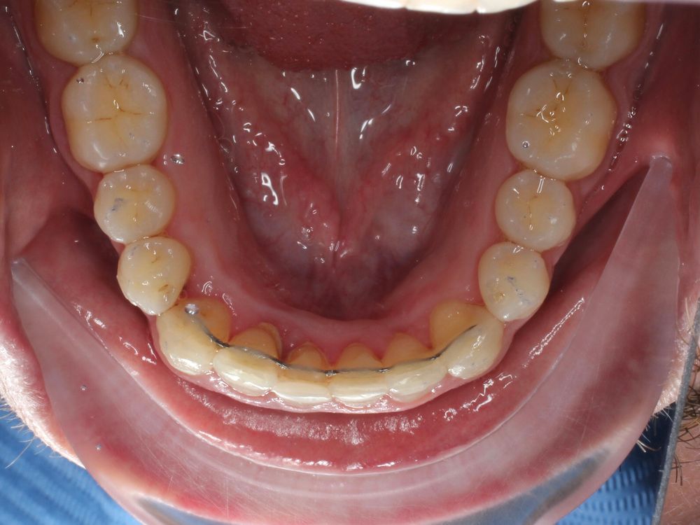 Close-up of lower teeth and gums, showing a dental retainer along the bottom front teeth.