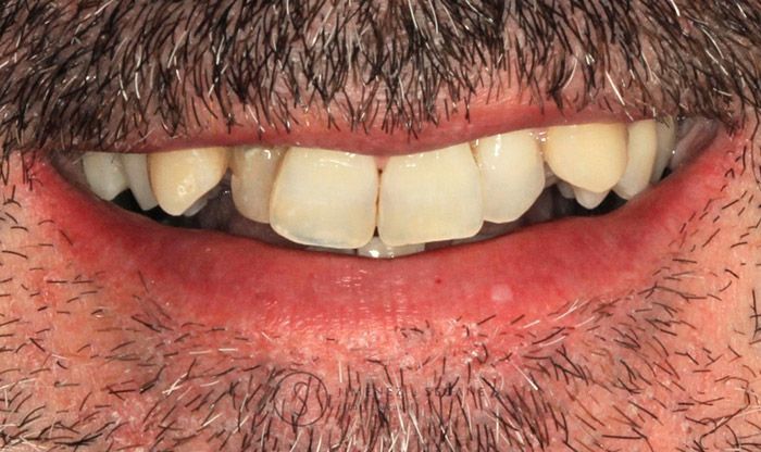 Primer plano de una boca sonriente con dientes, bigote y barba incipiente visibles.