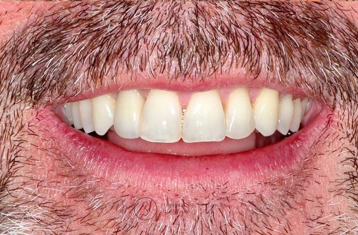 Primer plano de una boca sonriente con dientes blancos y barba incipiente alrededor de los labios.
