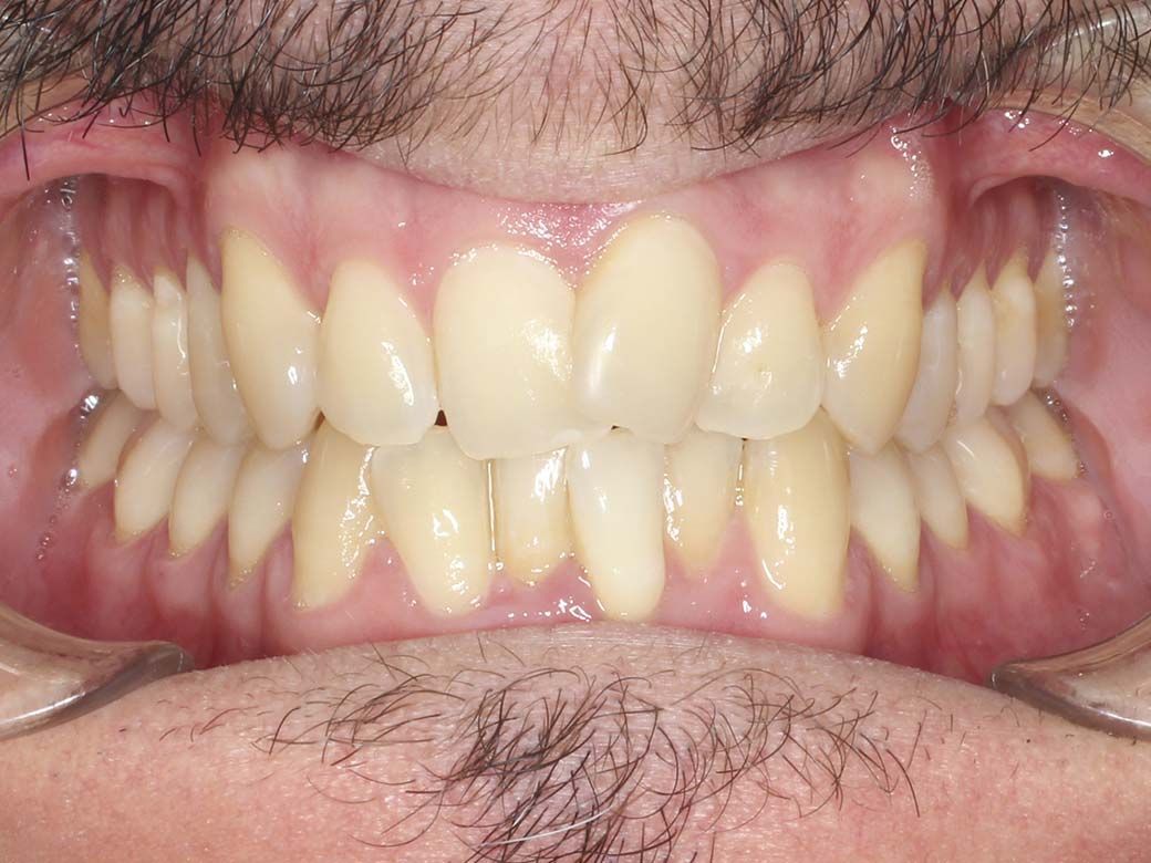 Un primer plano de la boca de una persona con sus dientes visibles.