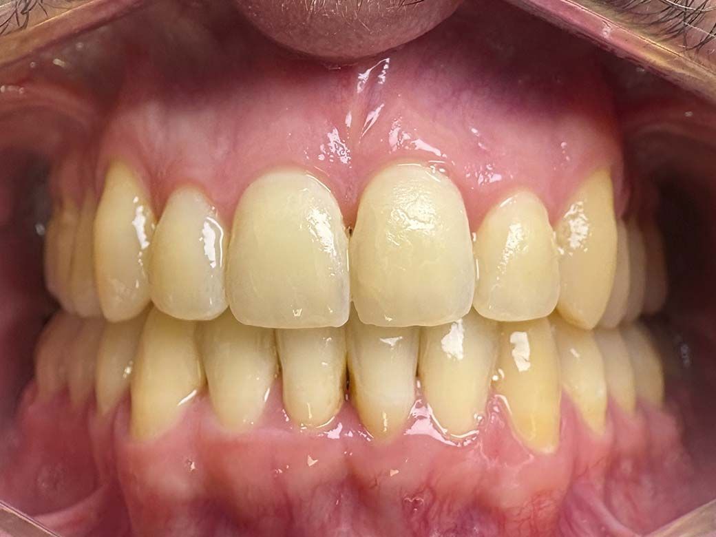 Un primer plano de la boca de una mujer con los dientes visibles.