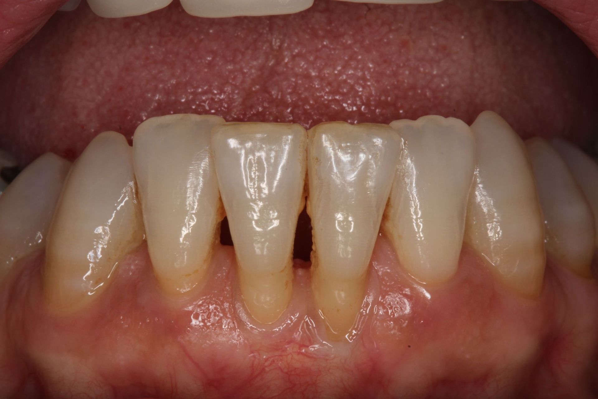 Primer plano de los dientes de una persona que muestra una coloración amarillenta en la base, las encías.