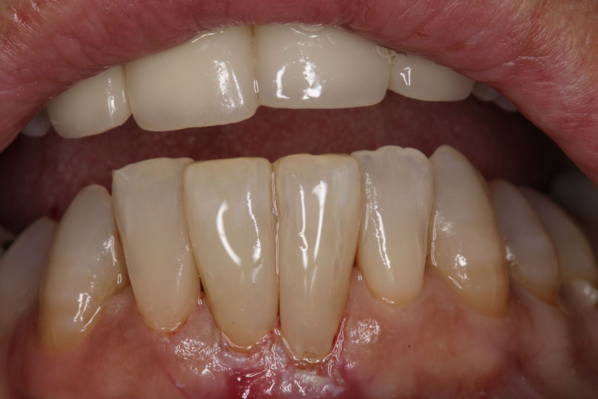 Primer plano de los dientes de una persona, mostrando las arcadas superior e inferior. Los dientes son blancos y lucen sanos.