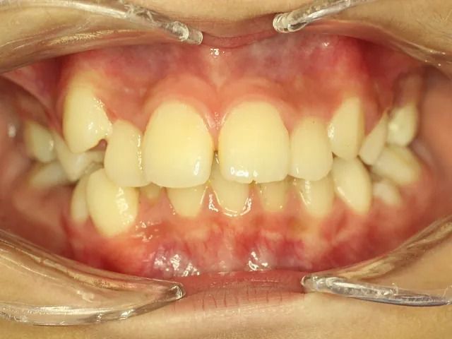Un primer plano de la boca de una persona con aparatos dentales.