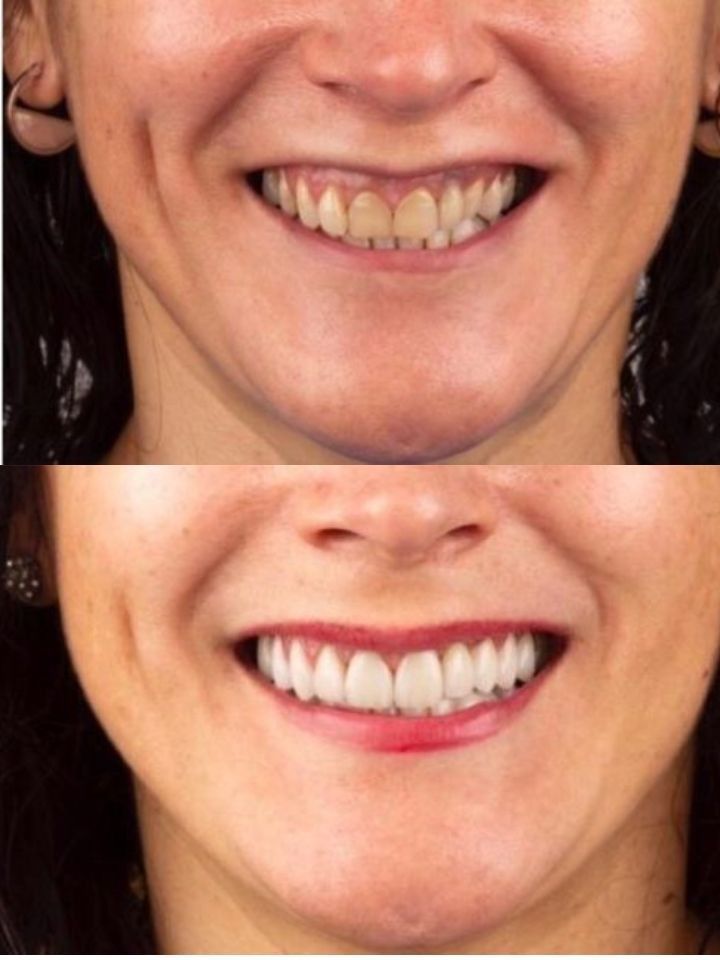 Una foto de antes y después de los dientes de una mujer.