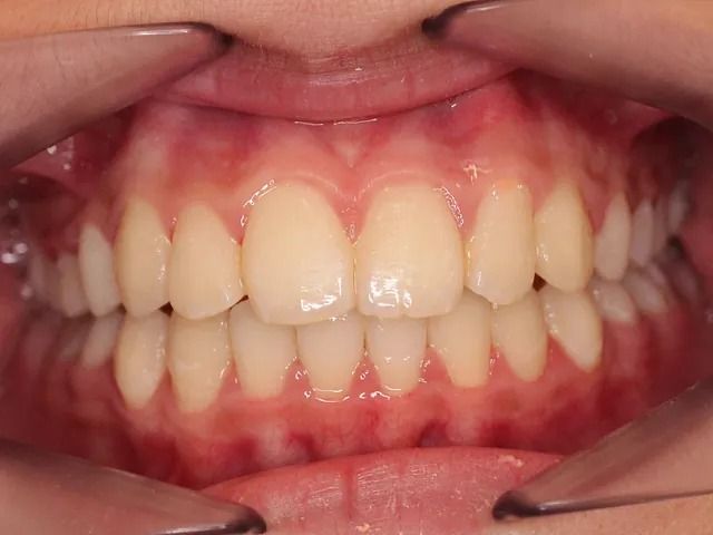 Un primer plano de la boca de una persona con dientes blancos.