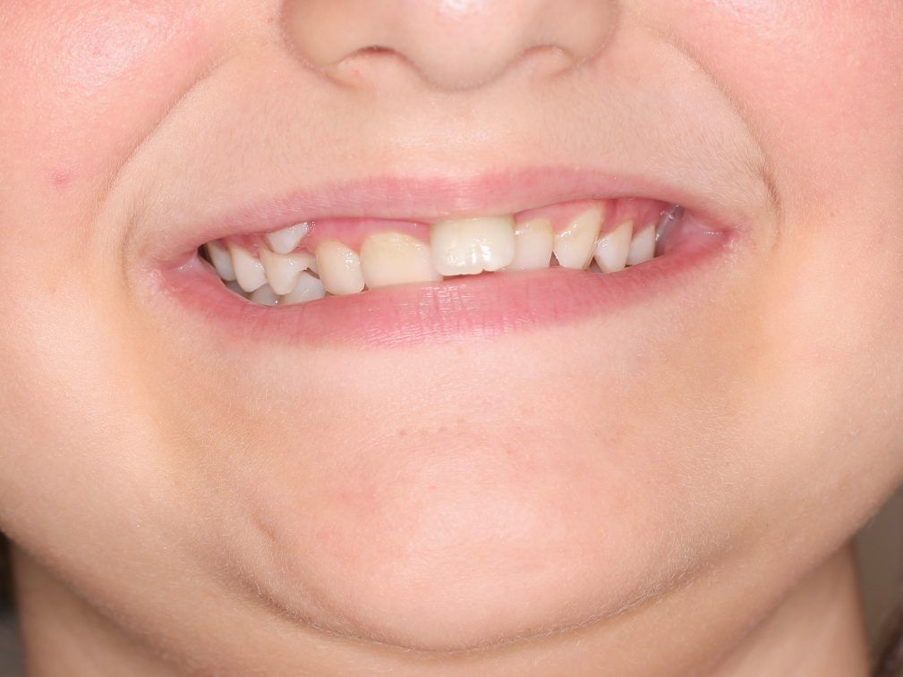 Un primer plano de la boca de una persona con sus dientes visibles.