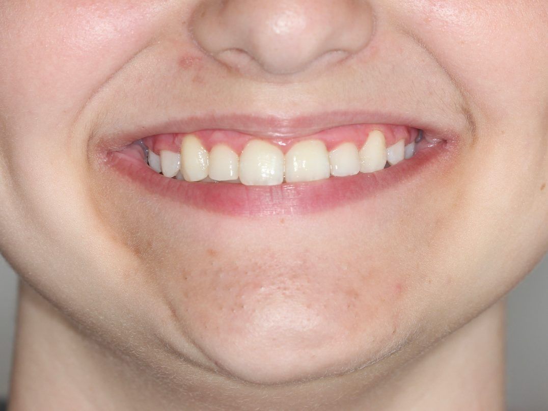 Un primer plano de la boca de una mujer con los dientes visibles.
