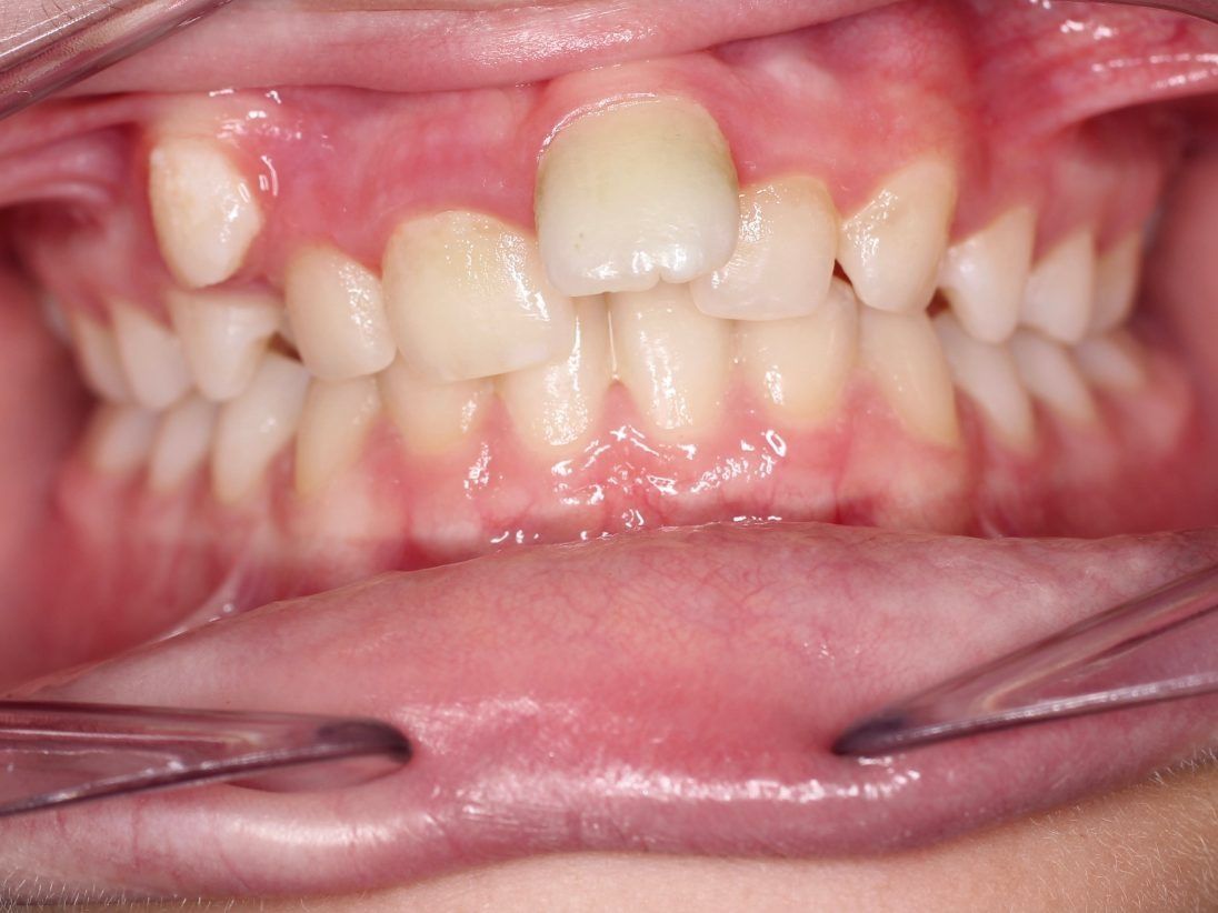 Un primer plano de los dientes de una persona con una corona en uno de ellos.
