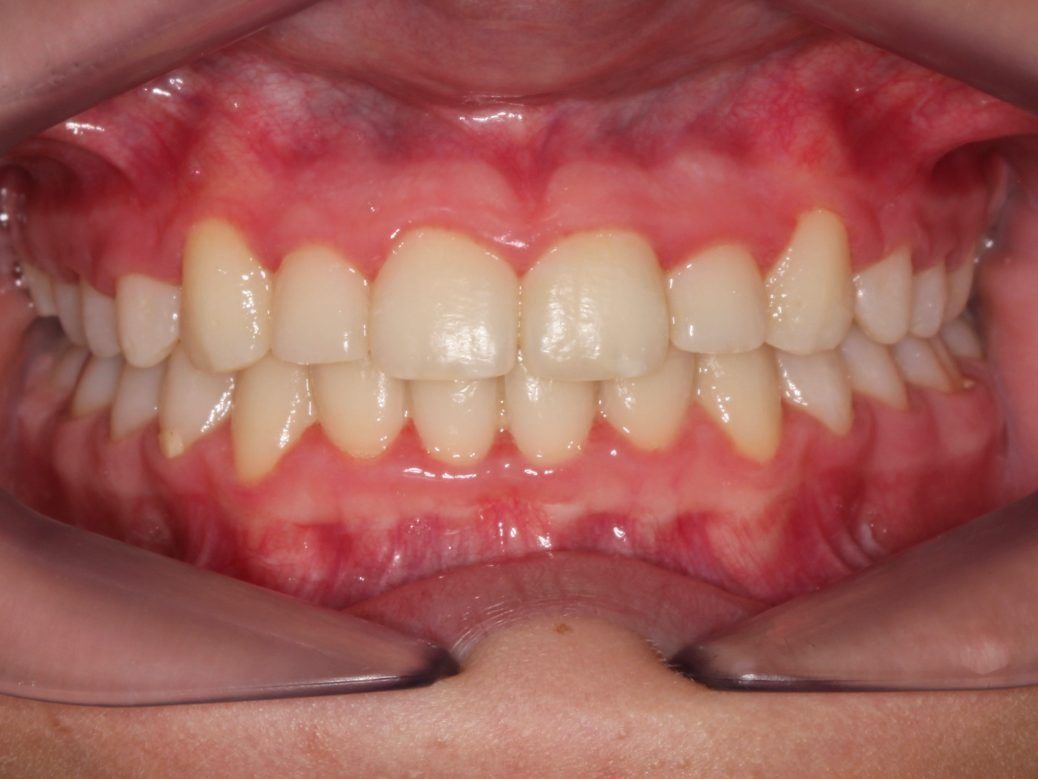 Un primer plano de los dientes de una persona con un protector bucal transparente.