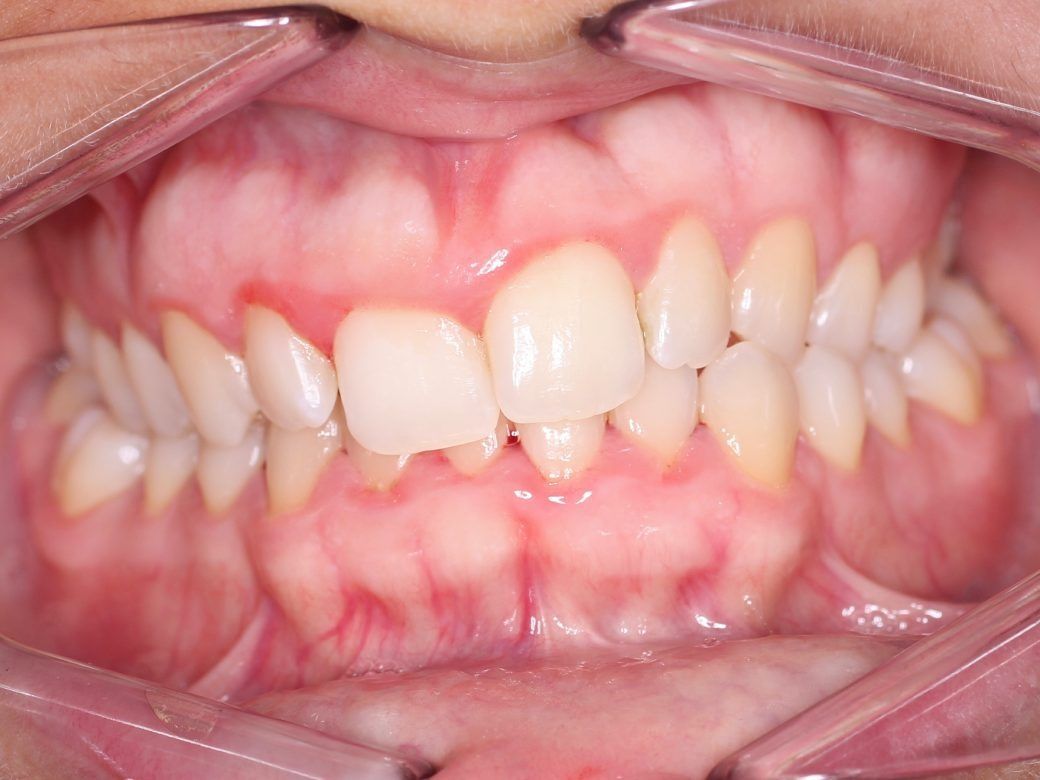Un primer plano de los dientes de una persona con un protector bucal.