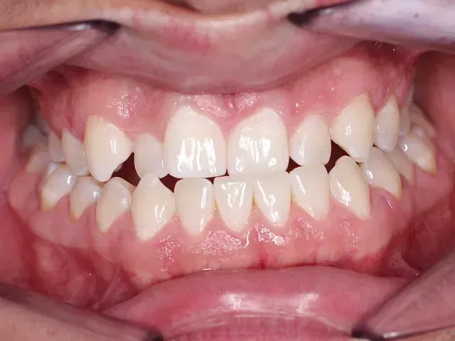 Un primer plano de la boca de una persona con dientes blancos.