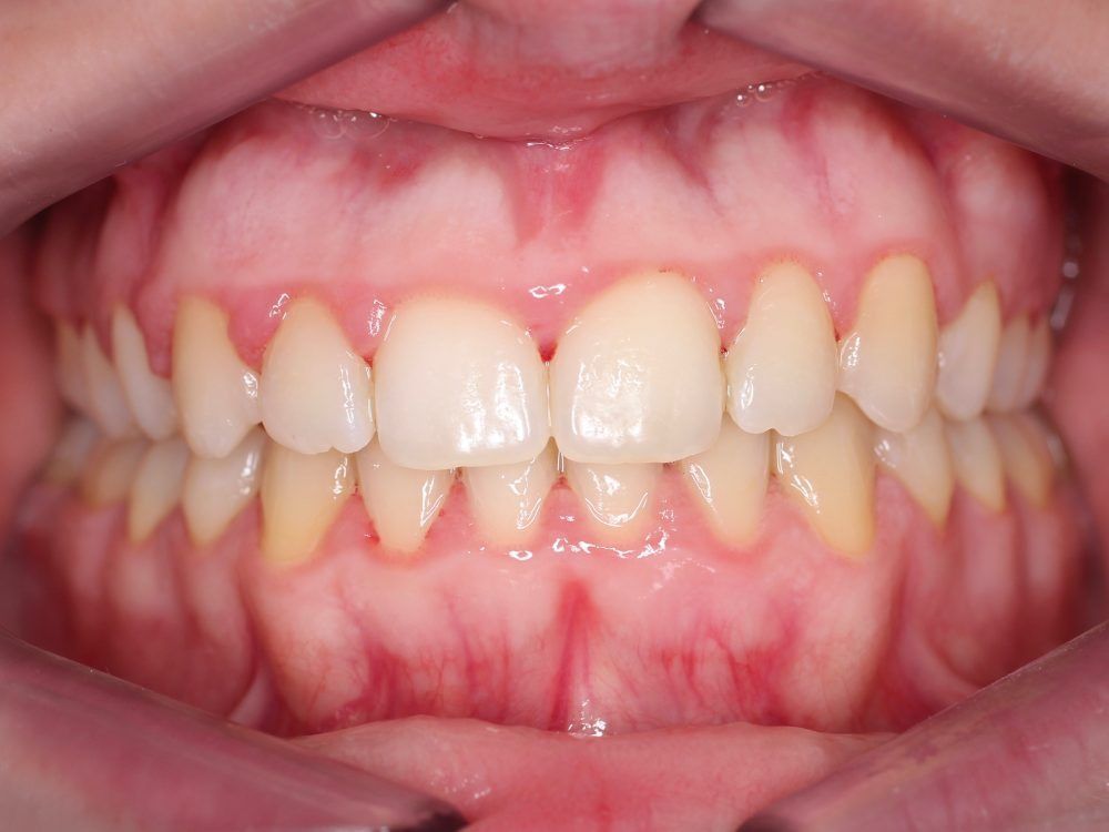 Un primer plano de la boca de una persona con dientes blancos y encías rojas.