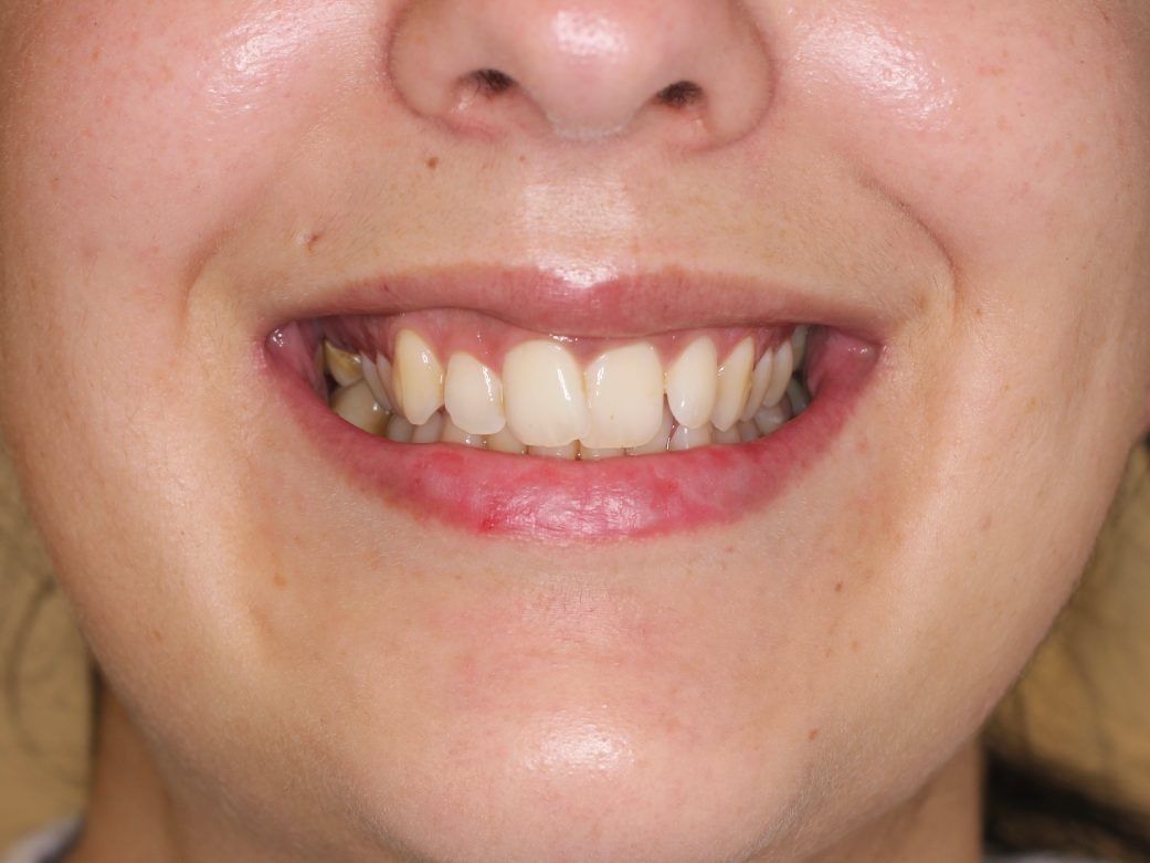 Un primer plano de la boca de una mujer mostrando sus dientes.
