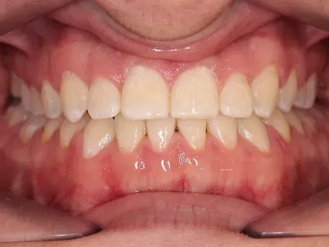 Un primer plano de los dientes de una persona con la boca abierta.