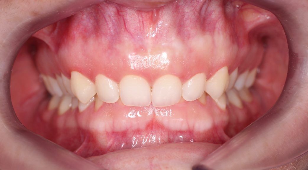 Un primer plano de la boca de una persona con sus dientes visibles.