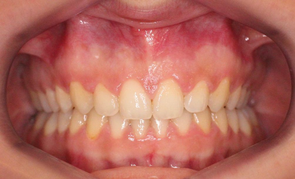 Un primer plano de la boca de una persona con dientes blancos y encías rojas.