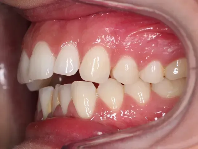 Un primer plano de los dientes de una persona con un protector bucal.