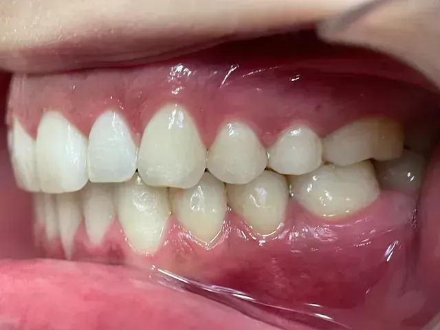 Un primer plano de los dientes y las encías de una persona.