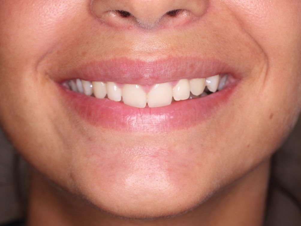 Un primer plano de la sonrisa de una mujer con dientes blancos.