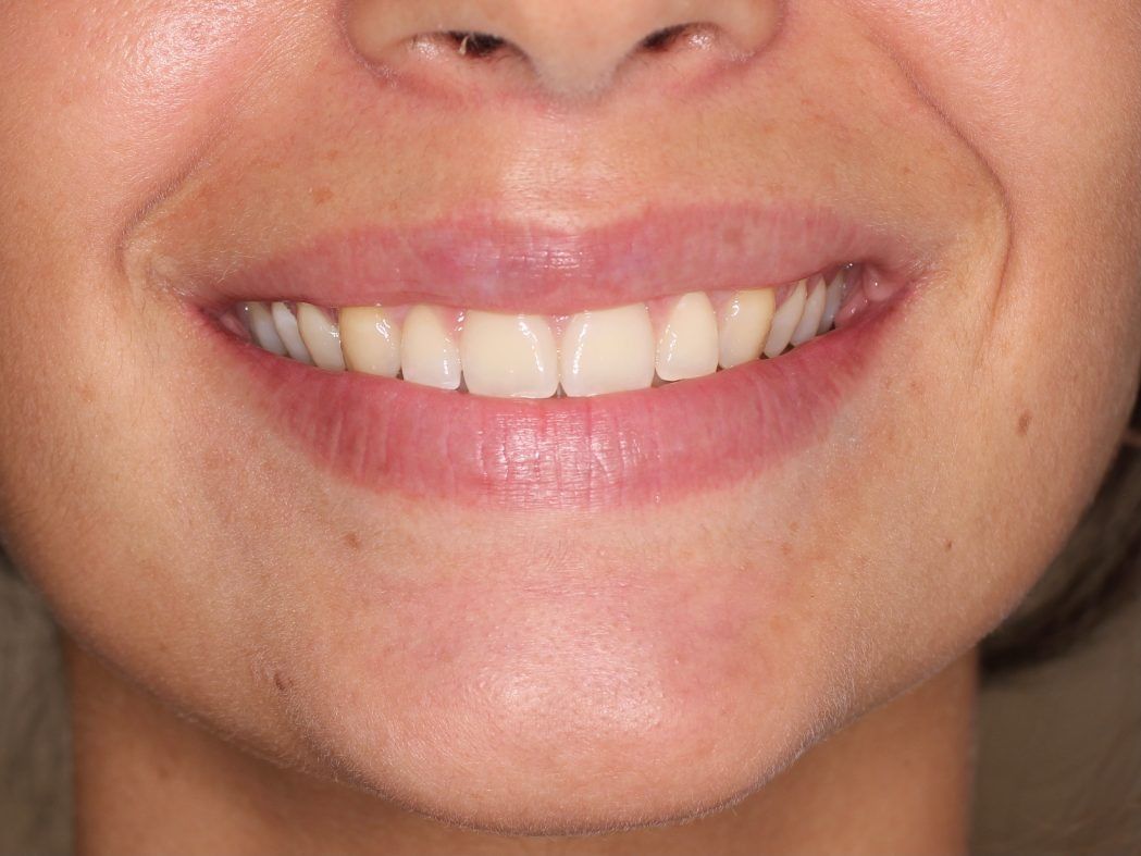 Un primer plano de la sonrisa de una mujer con dientes blancos.