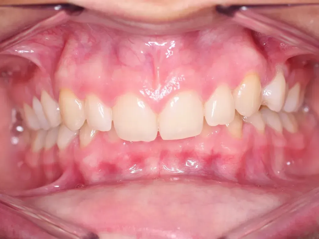 Un primer plano de los dientes de una persona con un protector bucal.
