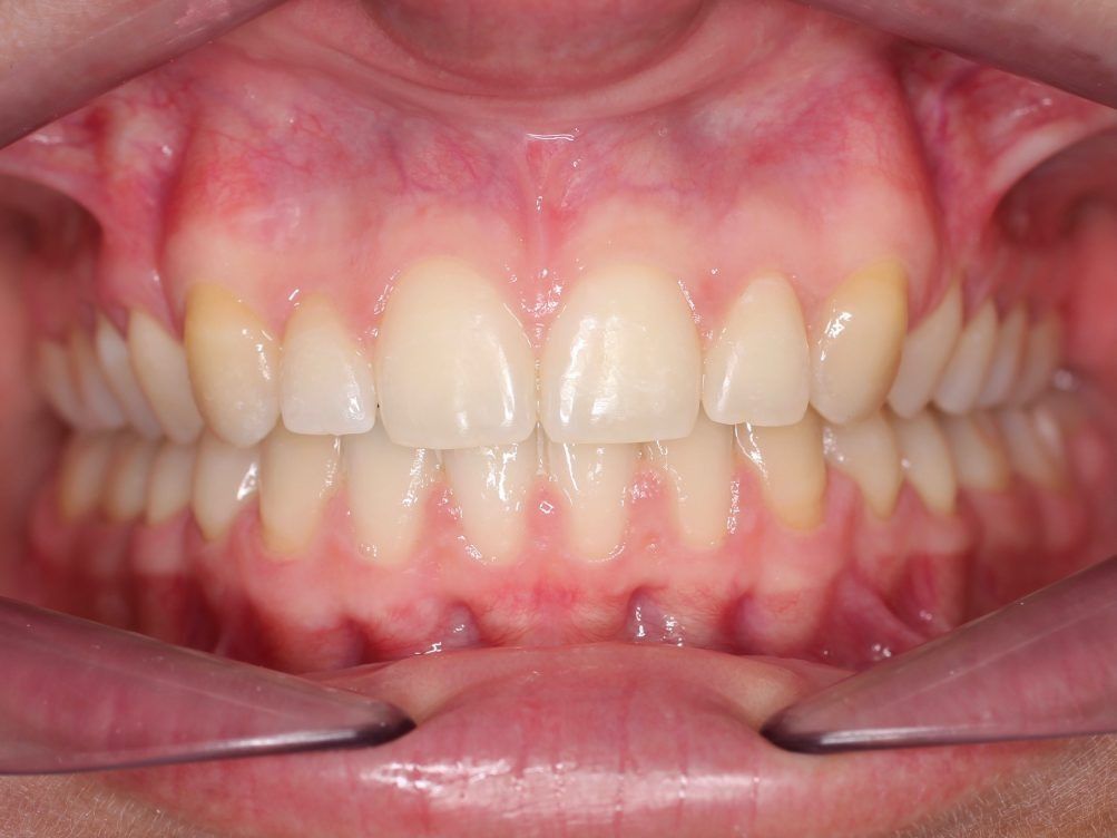 Un primer plano de los dientes de una persona con un protector bucal.