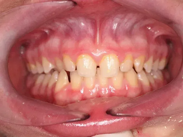 Un primer plano de la boca de una persona con sus dientes visibles.