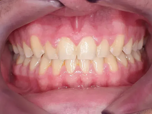 Un primer plano de la boca de una persona con sus dientes visibles.