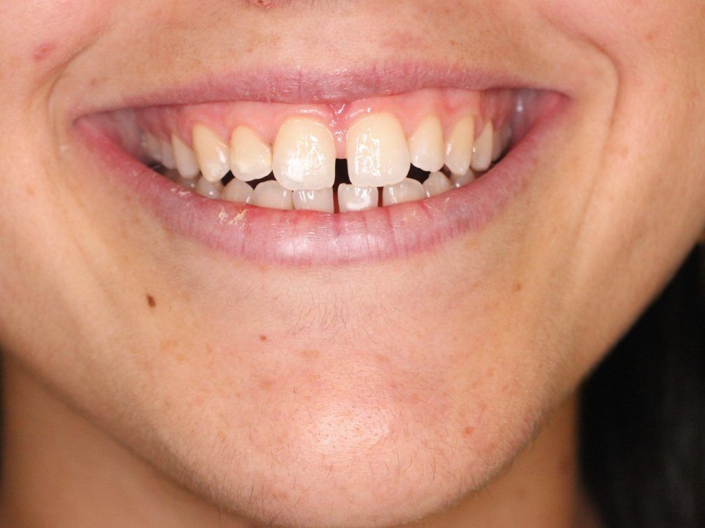Un primer plano de la sonrisa de una mujer con dientes faltantes.