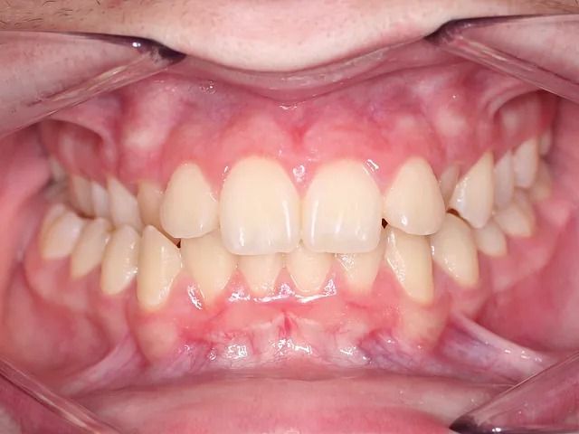 Un primer plano de los dientes de una persona con aparatos ortopédicos.