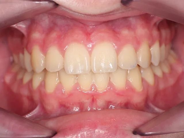 Un primer plano de los dientes de una persona con un protector bucal.