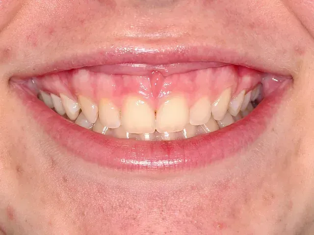 Un primer plano de la boca de una persona con sus dientes visibles.