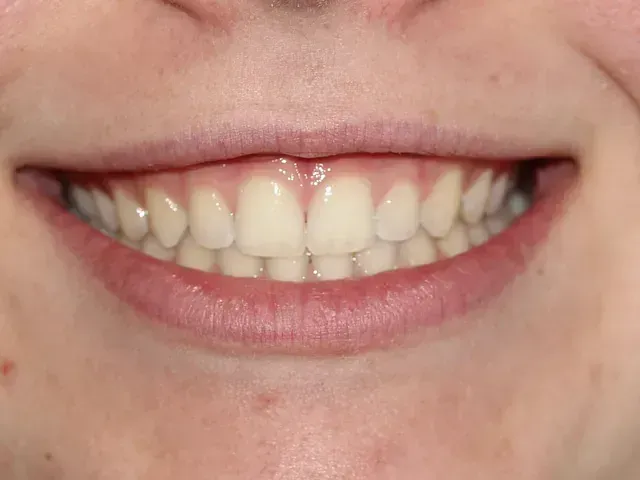 Un primer plano de la sonrisa de una persona con dientes blancos.