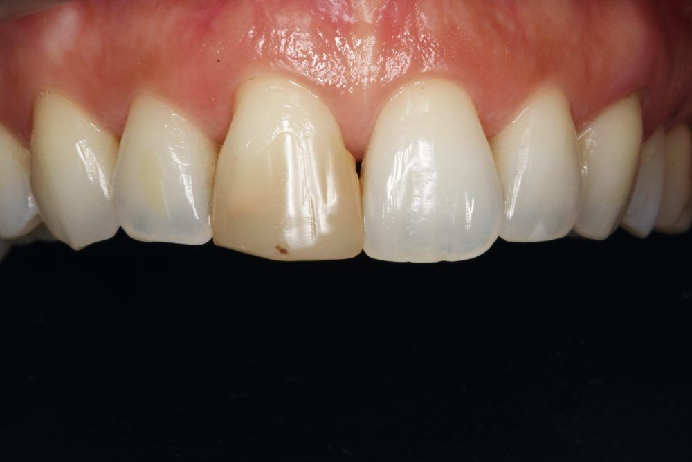 Un primer plano de los dientes de una persona sobre un fondo negro.