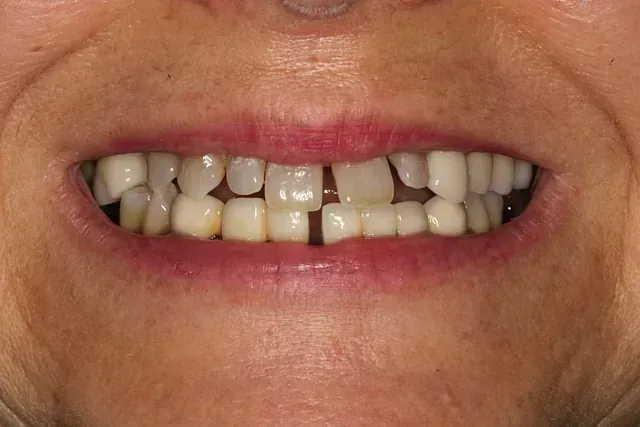Un primer plano de la boca de una mujer sin dientes.